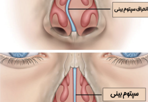 انحراف تیغه بینی